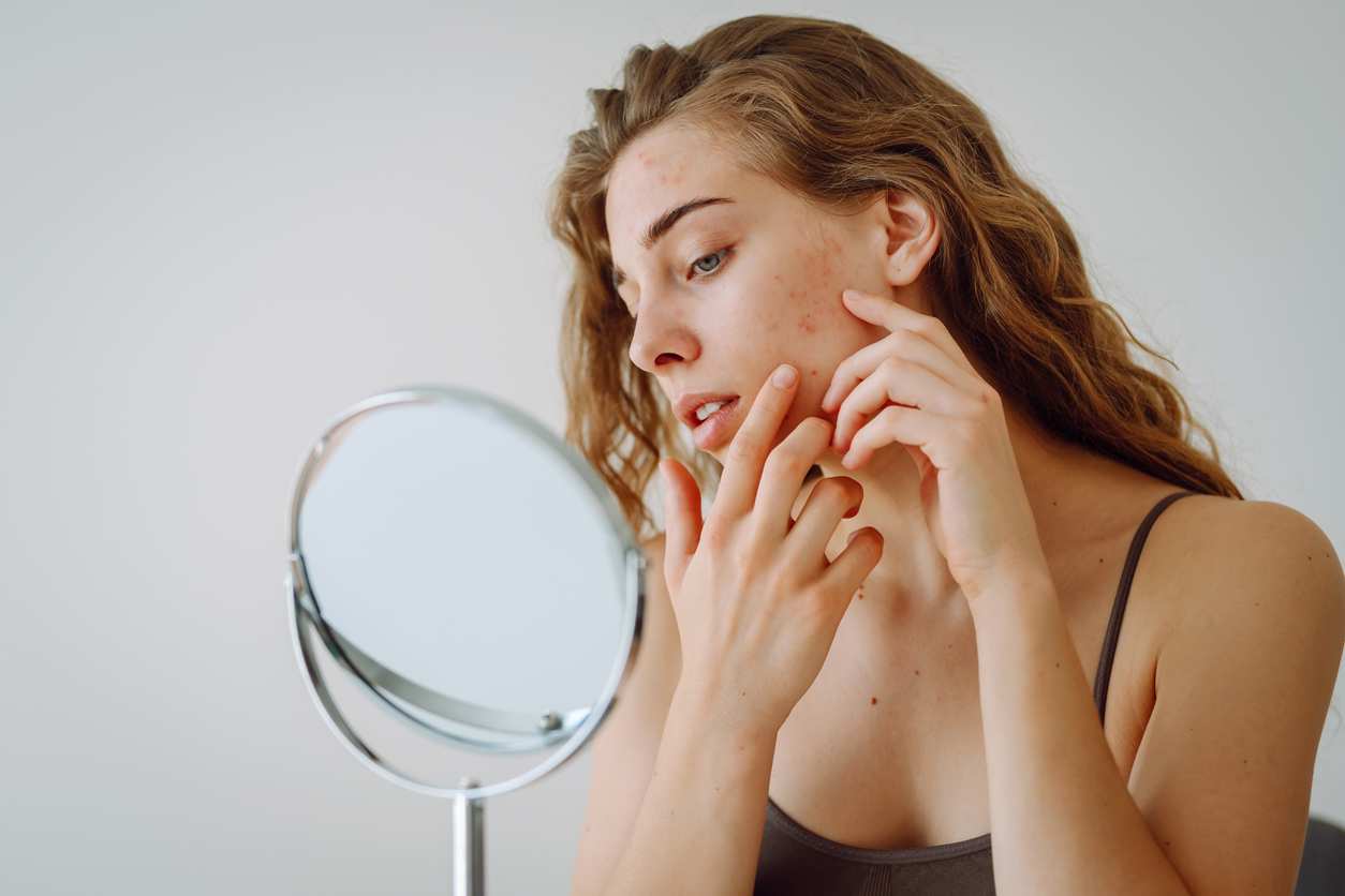 Acne scarring treatment at Leicester MediSpa