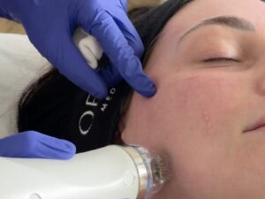 Acne scarring treatment at Leicester MediSpa