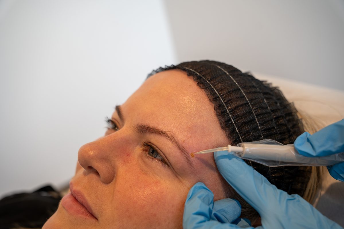 Skin lesion and skin tag removal at Leicester MediSpa